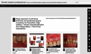 Ajouimplant.blogspot.com thumbnail