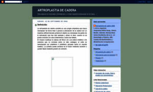 Artroplastia-de-cadera.blogspot.com thumbnail