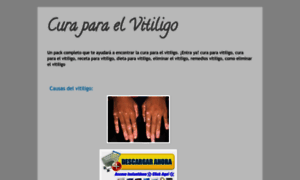 Curaparaelvitiligo.blogspot.com thumbnail