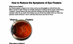 Cure-eye-floaters.com thumbnail